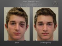 trauma repair before and after