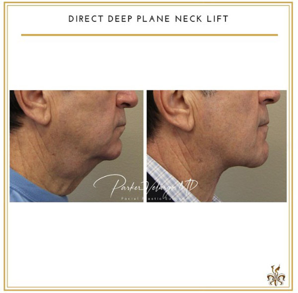 Direct Neck Lift New Orleans | New Orleans Center for Aesthetic ...