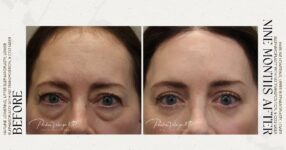 before and after deep brow lift front view female patient case 12316