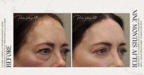 before and after deep brow lift right angle view female patient case 12316