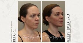 before and after deep brow lift right side angle view female patient case 12320