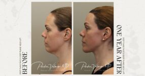 before and after deep brow lift left side view female patient case 12320