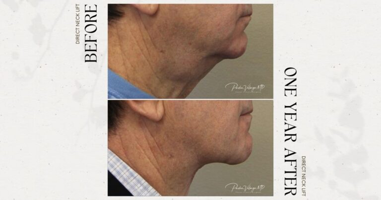 before and after neck lift male patient side view case 12277