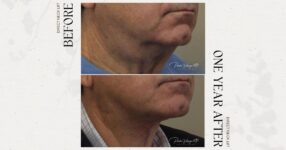 before and after neck lift male patient angle view case 12277