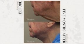before and after neck lift male patient left side view case 12284