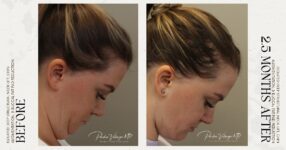 before and after deep structural neck lift right side down view female patient case 12353
