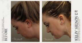 before and after deep structural neck lift left side view female patient case 12353