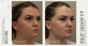 before and after deep structural neck lift right side angle view female patient case 12353