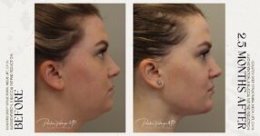 before and after deep structural neck lift right side view female patient case 12353