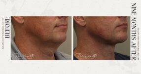 before and after deep structural neck lift right angle view male patient case 12362