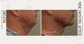 before and after deep structural neck lift right side view male patient case 12362