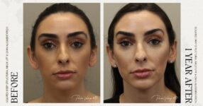 before and after deep structural neck lift right front view female patient case 12366
