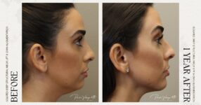 before and after deep structural neck lift right side view female patient case 12366