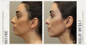before and after deep structural neck lift left side view female patient case 12366
