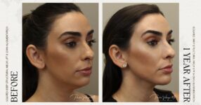 before and after deep structural neck lift right angle side view female patient case 12366