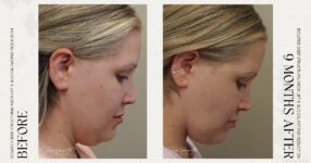 before and after deep structural neck lift side down view female patient case 12390