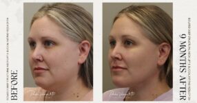 before and after deep structural neck lift left angle side view female patient case 12390