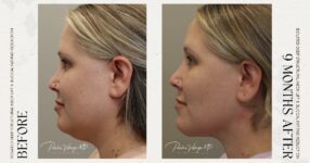 before and after deep structural neck lift left side view female patient case 12390
