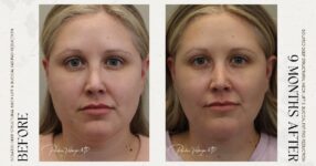 before and after deep structural neck lift front view female patient case 12390