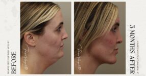 before and after deep structural neck lift side view female patient case 12399