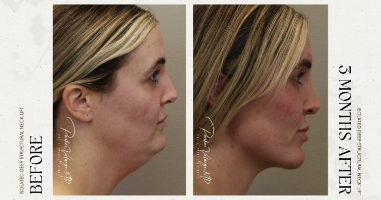 before and after deep structural neck lift side view female patient case 12399
