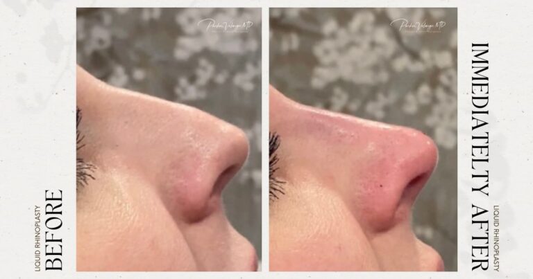 before and after non-surgical rhinoplasty female patient side view case 12293