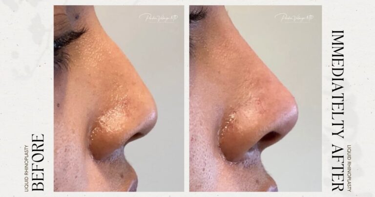 before and after non-surgical rhinoplasty female patient side view case 12295