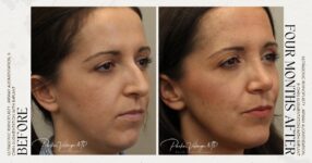before and after rhinoplasty female patient angle view case 12250