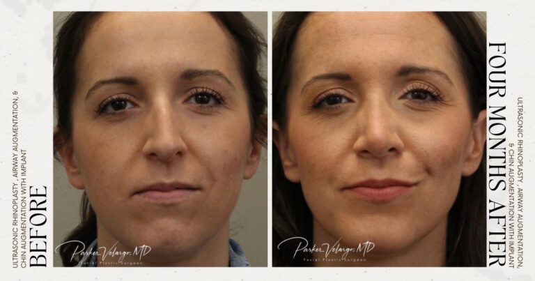 before and after rhinoplasty female patient front view case 12250
