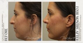 before and after rhinoplasty female patient left side view case 12250