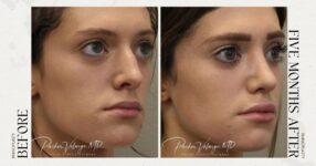 before and after rhinoplasty female patient angle view case 21255