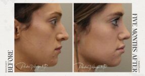 before and after rhinoplasty female patient side view case 12255