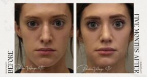 before and after rhinoplasty female patient front view case 21255