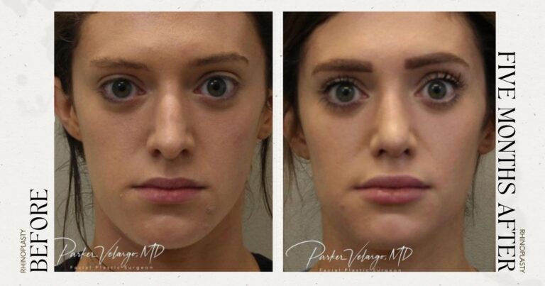 before and after rhinoplasty female patient front view case 21255