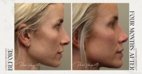 before and after rhinoplasty female patient side view case 21259