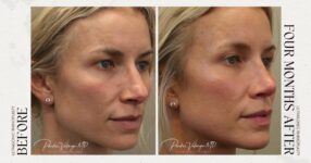 before and after rhinoplasty female patient angle view case 21259