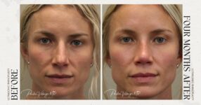 before and after rhinoplasty female patient front view case 21259
