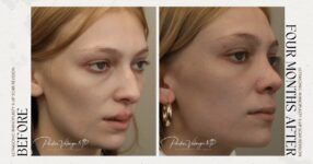 before and after rhinoplasty female patient angle view case 12266