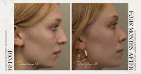 before and after rhinoplasty female patient side view case 12266