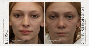 before and after rhinoplasty female patient front view case 12266