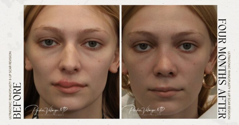 before and after rhinoplasty female patient front view case 12266