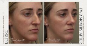 before and after rhinoplasty female patient angle view case 12276