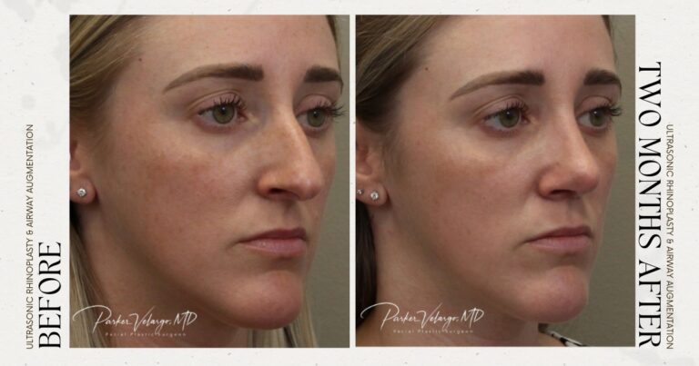 before and after rhinoplasty female patient angle view case 12276