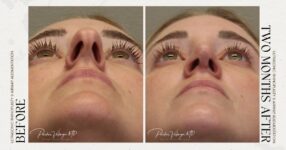 before and after rhinoplasty female patient bottom view case 12276
