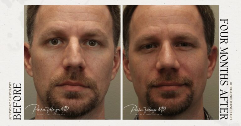 before and after rhinoplasty male patient front view case 12283