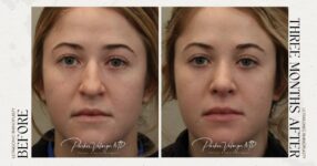 before and after rhinoplasty female patient front view case 12297
