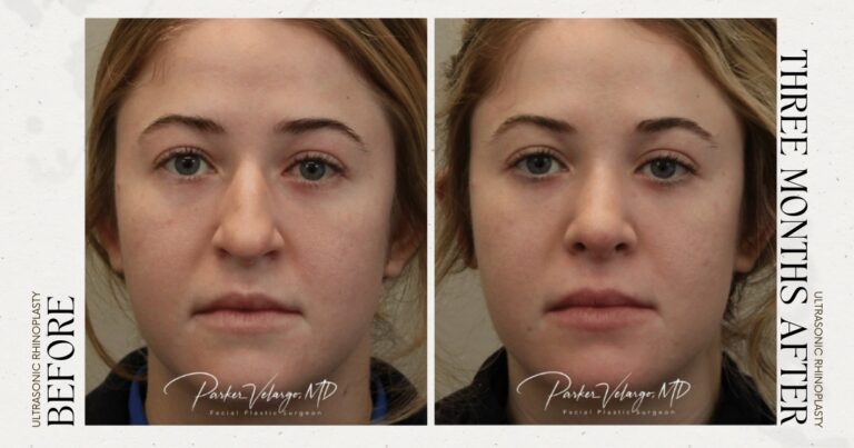 before and after rhinoplasty female patient front view case 12297
