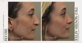 before and after rhinoplasty female patient right side view case 12303