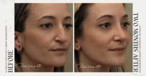 before and after rhinoplasty female patient right angle view case 12303
