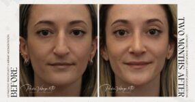 before and after rhinoplasty female patient front view case 12303